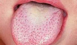 吃瓜舌头有泡泡,揭秘吃瓜时的奇妙现象