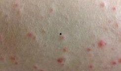 紫癜患儿可以吃拂手瓜吗,紫癜患儿适宜食用拂手瓜的探讨