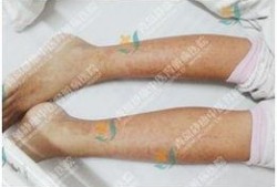 紫癜患儿可以吃拂手瓜吗,紫癜患儿适宜食用拂手瓜的探讨