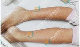 紫癜患儿可以吃拂手瓜吗,紫癜患儿适宜食用拂手瓜的探讨