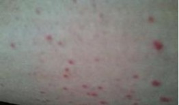 紫癜患儿可以吃拂手瓜吗,紫癜患儿适宜食用拂手瓜的探讨