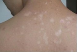 白癜风吃瓜可以吗,吃瓜需谨慎，了解饮食禁忌