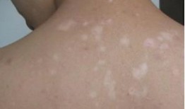 白癜风吃瓜可以吗,吃瓜需谨慎，了解饮食禁忌